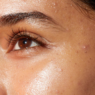 A close-up of a person's upper cheek and temple area under bright sunlight. The skin has a glossy finish, revealing several small, scattered acne blemishes, minor bumps, and a raised whitehead near the outer edge of the face.