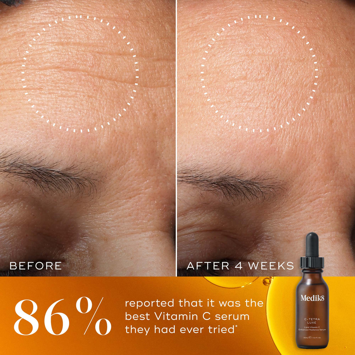 Before and after comparison of a participant’s forehead over 4 weeks, with a white dotted circle highlighting a visible reduction in the look of fine lines and wrinkles. The bottom of the image features a warm orange-gold background with a Medik8 C-Tetra Luxe serum bottle and the claim  86% reported that it was the best Vitamin C serum they had ever tried*. 