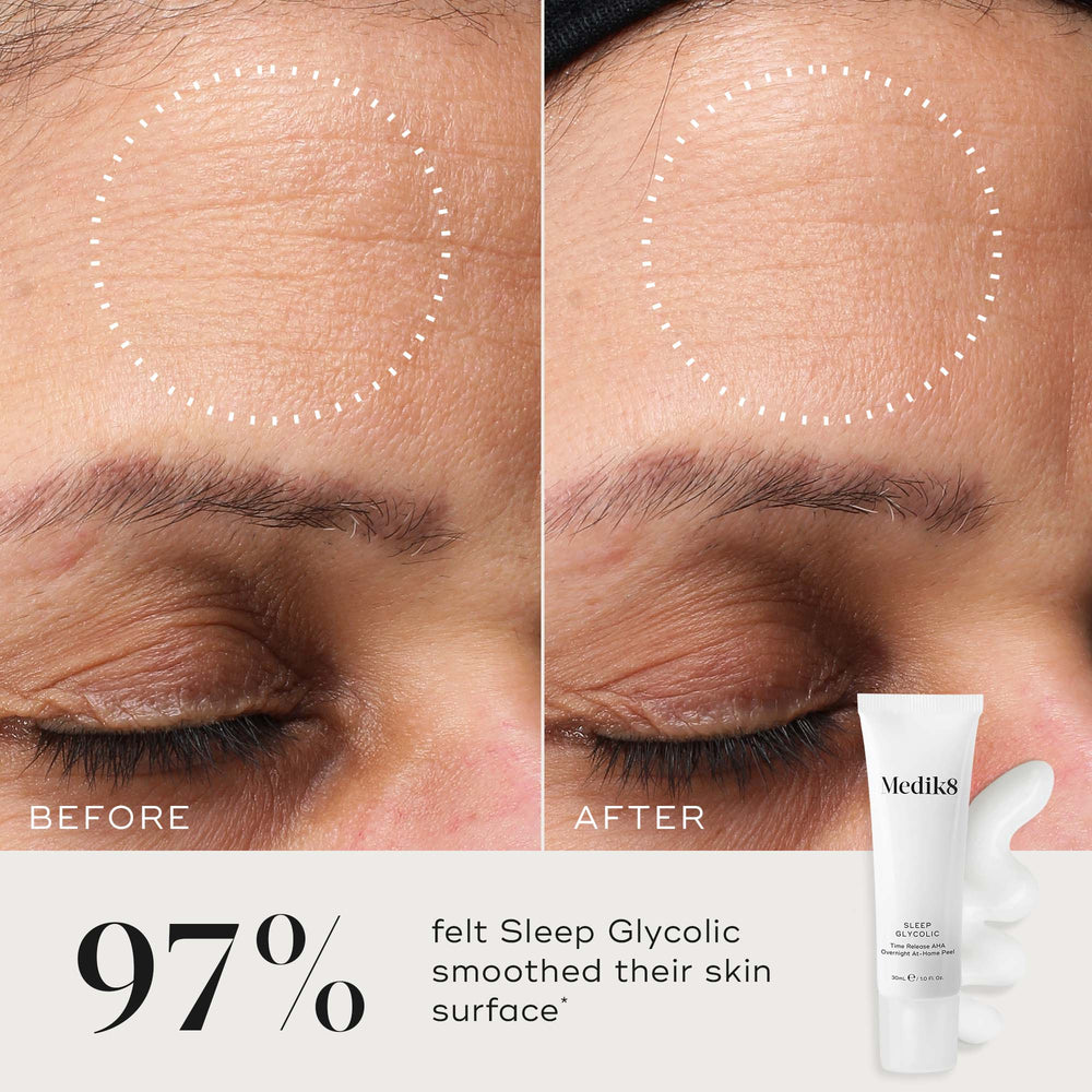 Before and after close-up of a participant’s skin on the forehead, demonstrating a visibly smoother skin texture and refined appearance. The Medik8 Sleep Glycolic tube and a white cream texture swipe are shown in the corner against a neutral background. Text highlights that  97% felt Sleep Glycolic smoothed their skin surface*. 