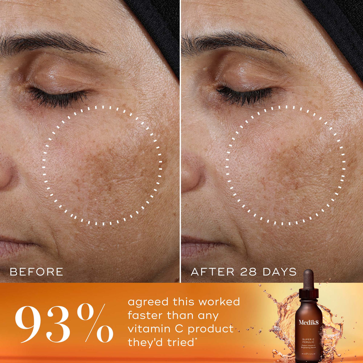 A side-by-side  Before  and  After 28 Days  comparison of a person's cheek and eye area. A white dashed circle highlights a reduction in the appearance of dark spots and uneven pigmentation in the  After  image. A bold orange banner at the bottom features the statement:  93% agreed this worked faster than any vitamin C product they'd tried* . The Super C Ferulic serum bottle is shown in the bottom right corner against a splashing amber liquid background.