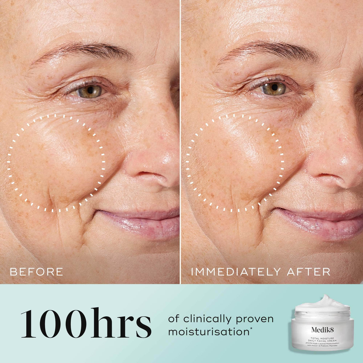 A split-screen before-and-after comparison of a woman's cheek and eye area, with a dotted circle highlighting visibly plumped skin and reduced wrinkles in the "IMMEDIATELY AFTER" photo. Text states "100 hours of clinically proven moisturisation*" alongside an image of the Medik8 Total Moisture jar.