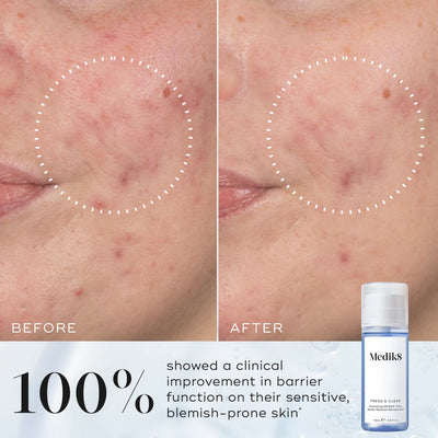 Side-by-side comparison labelled  Before  and  After  showing reduced redness and clearer skin inside a dotted circle. Text states  100% showed a clinical improvement in barrier function on their sensitive, blemish-prone skin* .