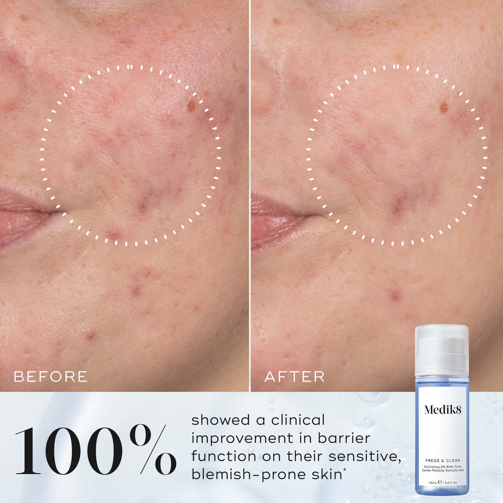 Side-by-side comparison labelled  Before  and  After  showing reduced redness and clearer skin inside a dotted circle. Text states  100% showed a clinical improvement in barrier function on their sensitive, blemish-prone skin* .