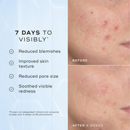 A split image showing a close-up of skin texture labelled "Before" and "After 4 Weeks," highlighting improvements. Text on the left lists benefits: "Reduced blemishes," "Improved skin texture," "Reduced pore size," and "Soothed visible redness."