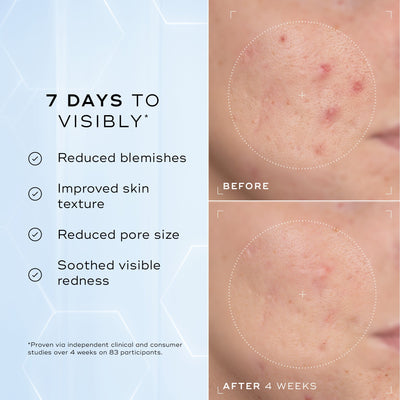 A split image showing a close-up of skin texture labelled "Before" and "After 4 Weeks," highlighting improvements. Text on the left lists benefits: "Reduced blemishes," "Improved skin texture," "Reduced pore size," and "Soothed visible redness."